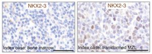 Expresión de NKX2-3 de en células B sanos (izquierda) y células B de linfoma de zona marginal (derecha)