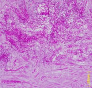 Tinción histológica de un corte de riñon infectado por candida donde se aprecian las hifas del hongo en forma de filamenos