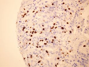 Linfocitos citotóxicos (en marrón) infiltrando un tumor colorectal con altos niveles de SOD3. 