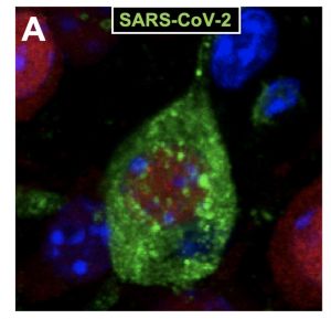 Neurona de la corteza cerebral infectada con SARS-CoV2 (partículas virales en verde)